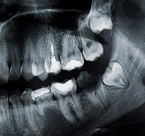 X-ray imaging of wisdom teeth