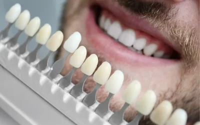 What are Dental Veneers?