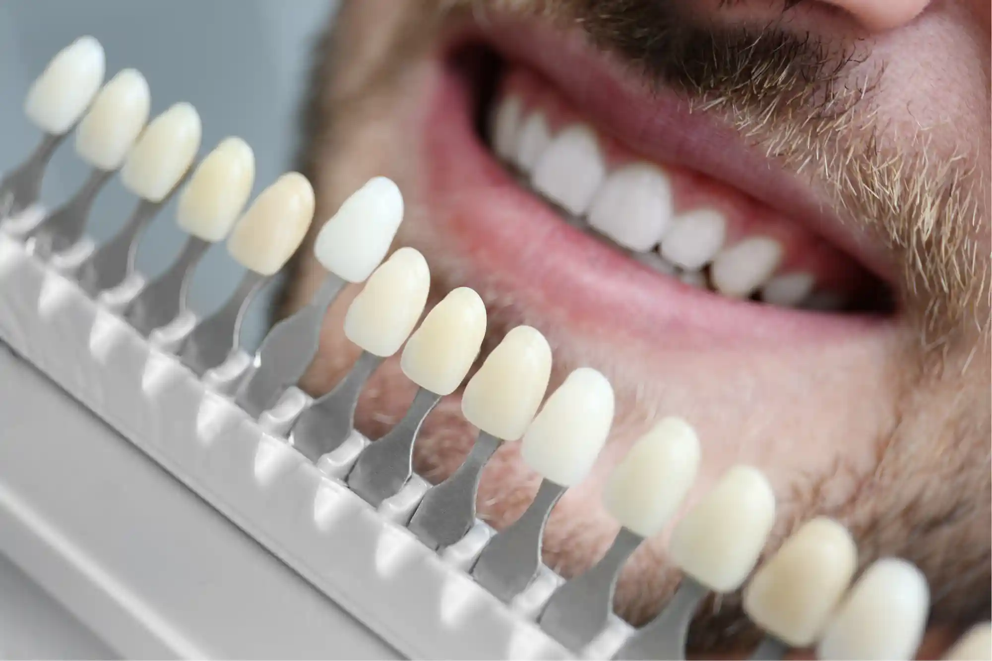 what are dental veneers