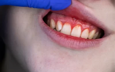 Red Bumps on Gums