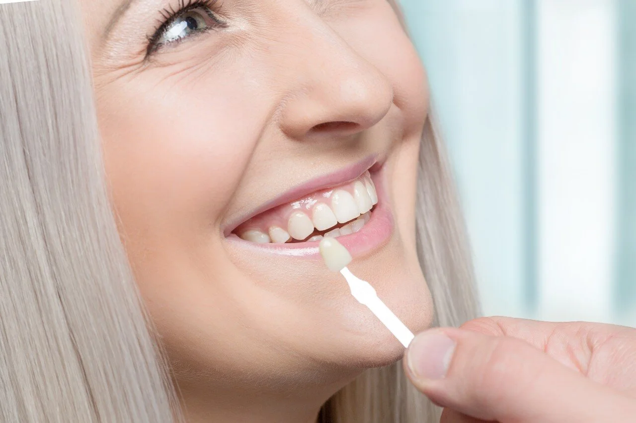 What are Dental Veneers?