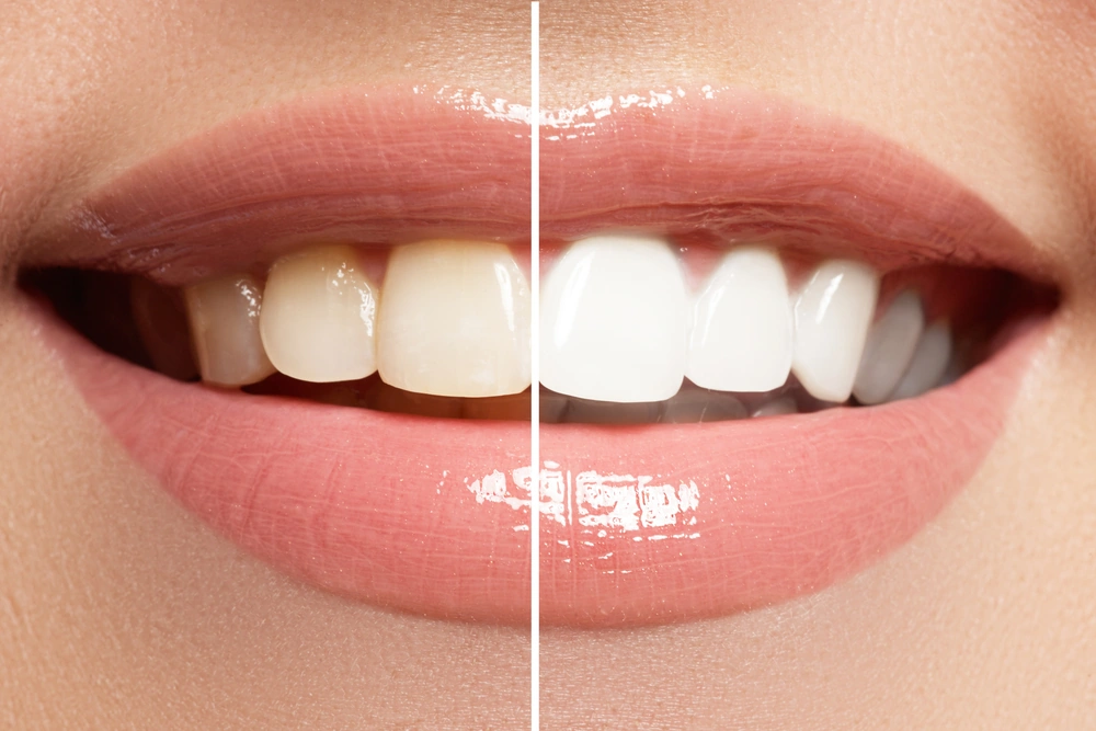 Celebrate National Teeth Whitening Day – June 17th